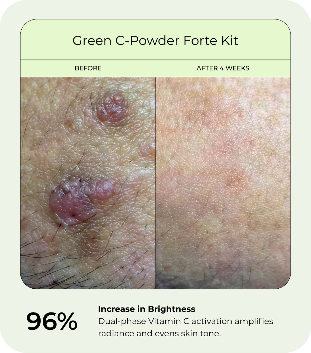 Before and after close-up of skin showing increased brightness after 4 weeks of use with DrJ SkinClinic Green C-Powder Forte Kit, with more even-looking tone and improved skin radiance.