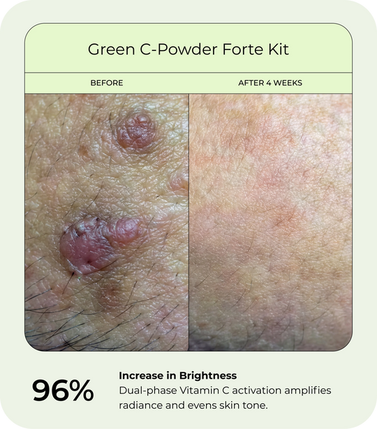 Before and after close-up of skin showing increased brightness after 4 weeks of use with DrJ SkinClinic Green C-Powder Forte Kit, with more even-looking tone and improved skin radiance.
